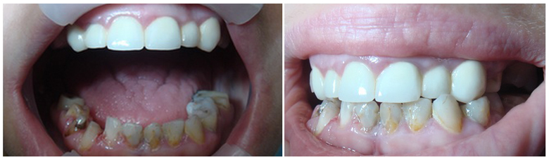 Celková rekonštrukcia zubov