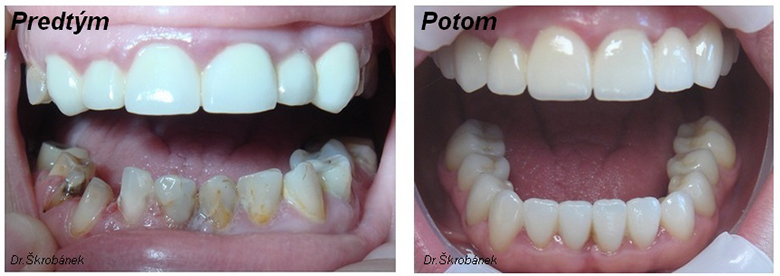 Celková rekonštrukcia zubov