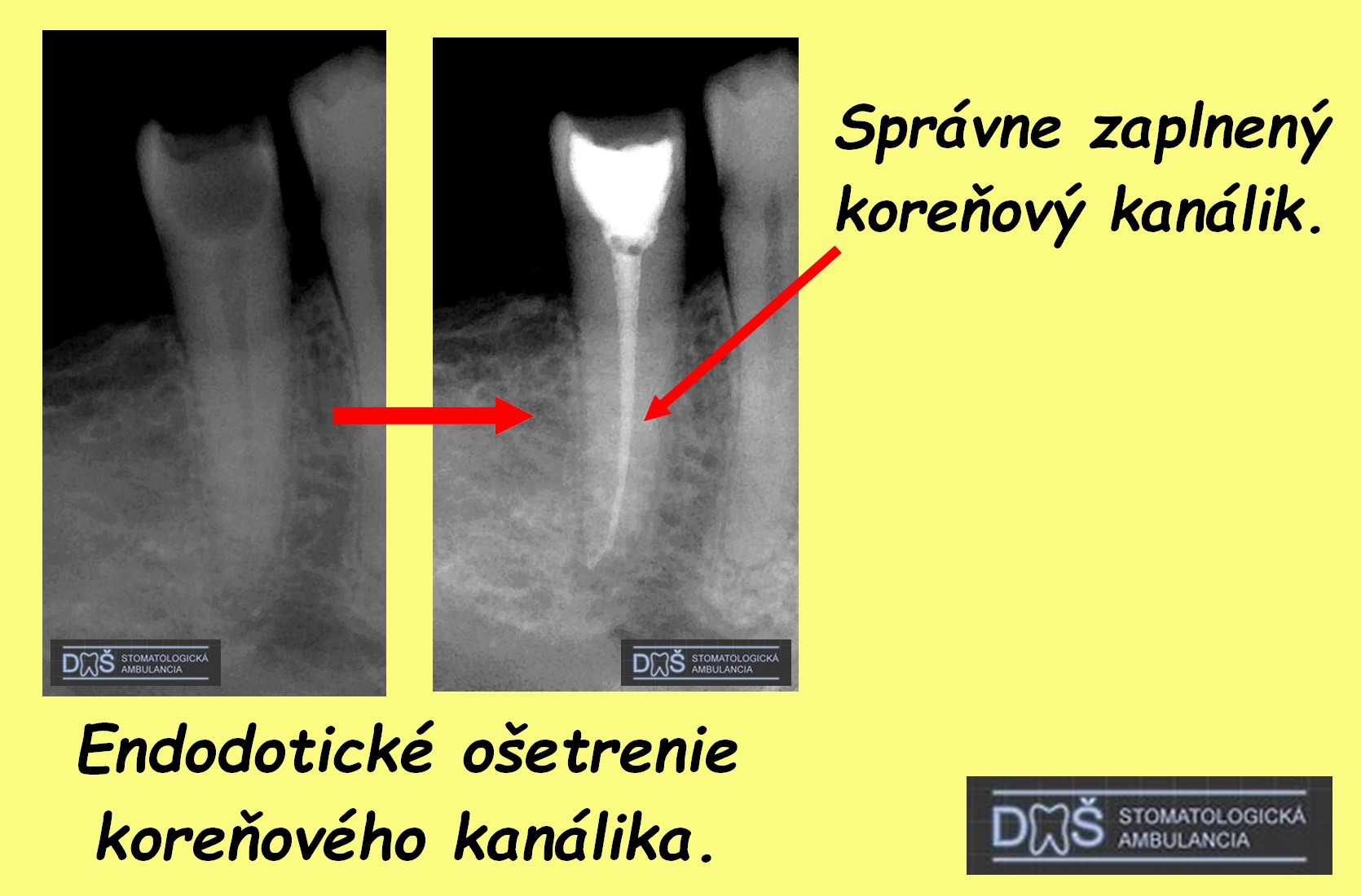 rtg endodoncia